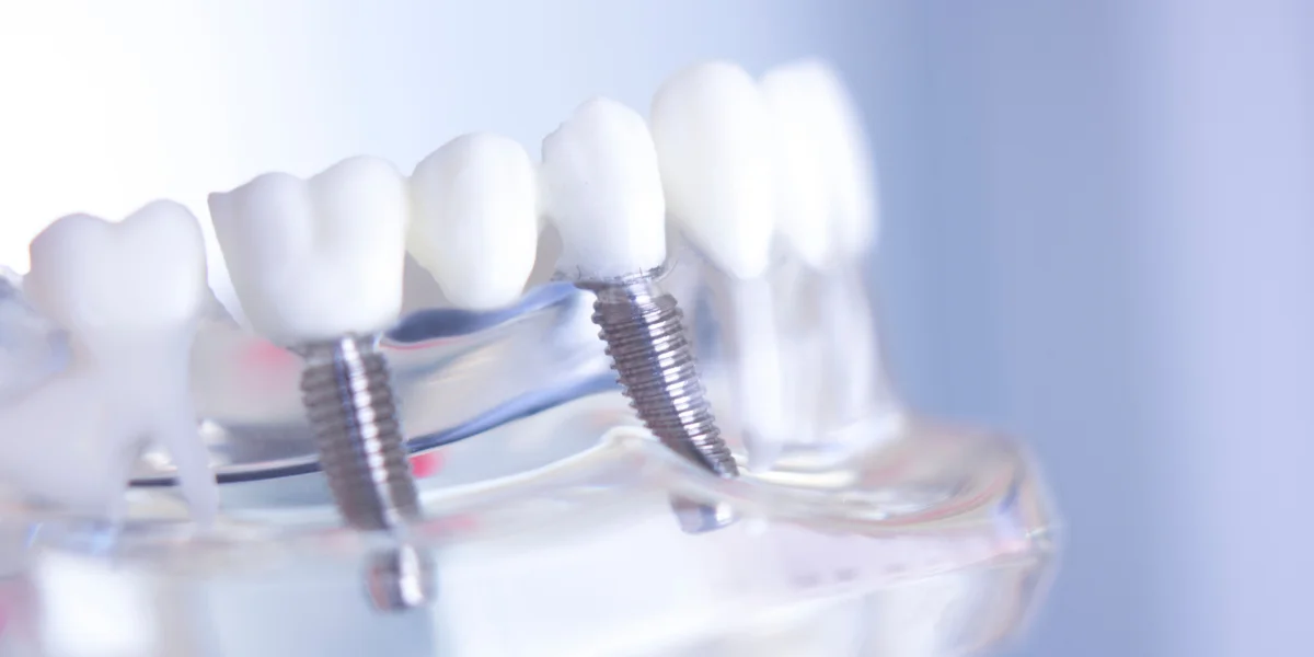 All-On-6 Dental Implants Banner