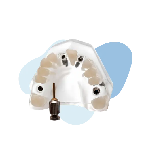 All On X Dental Implant Image