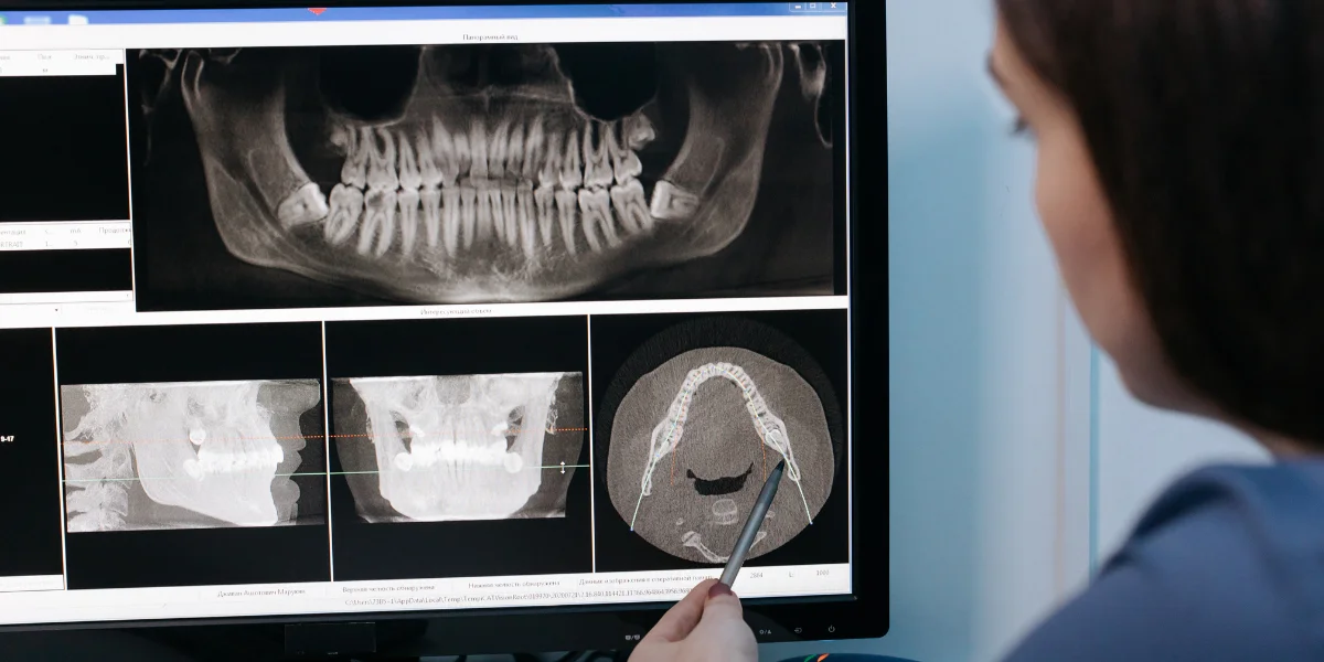 Dental Implant Banner