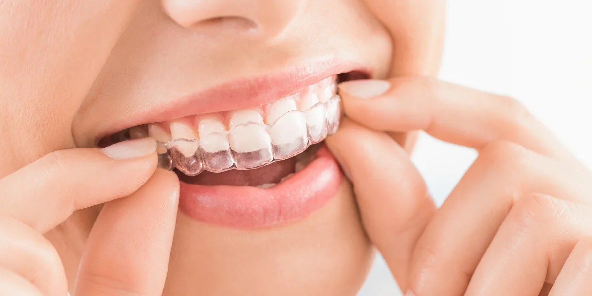 Invisalign Banner