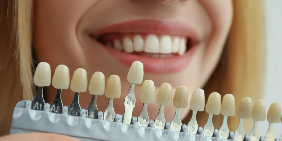 Veneers Banner